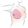 Mastectomia totale